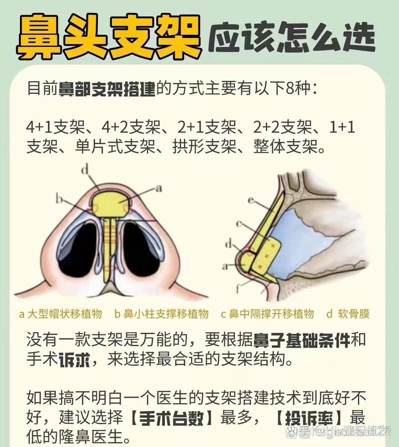 假体隆鼻要注意什么