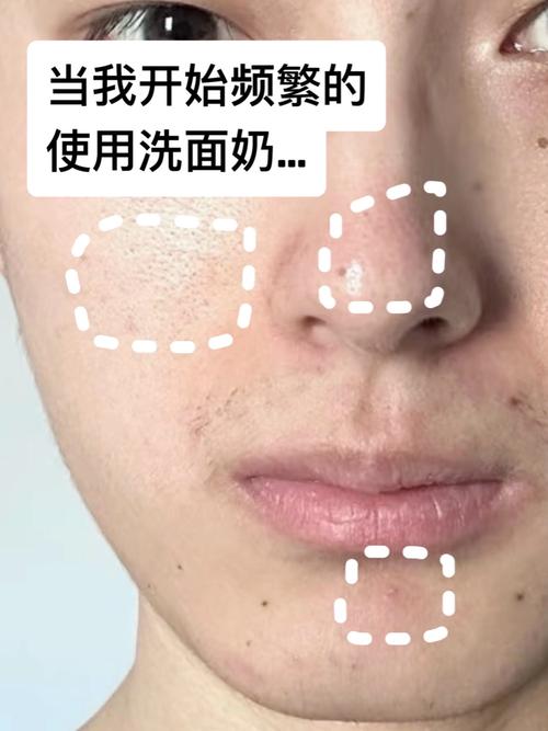 用了带颗粒的洗面奶皮肤变得很差该怎么办