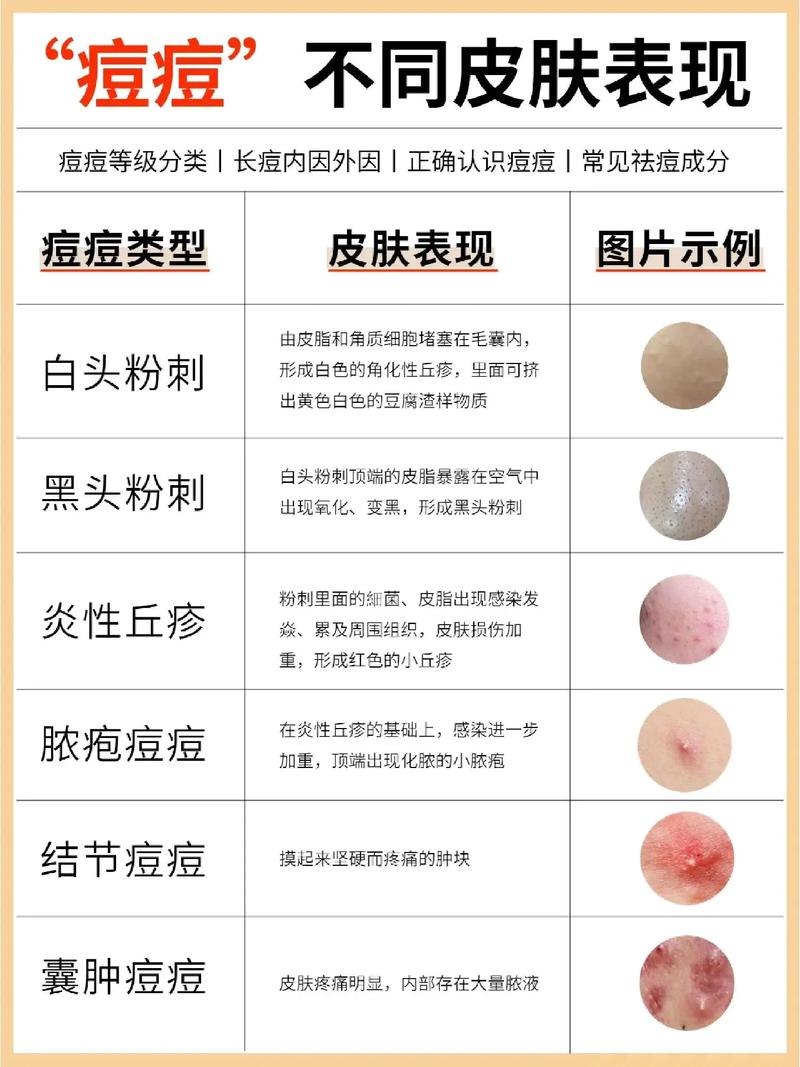 为什么脸上很多粉刺