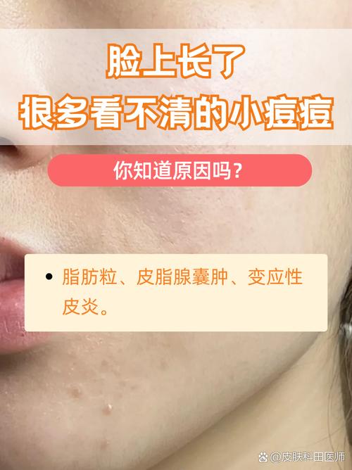 为什么脸上很多粉刺