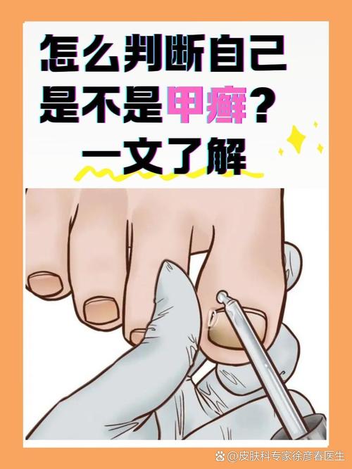 甲癣是什么病
