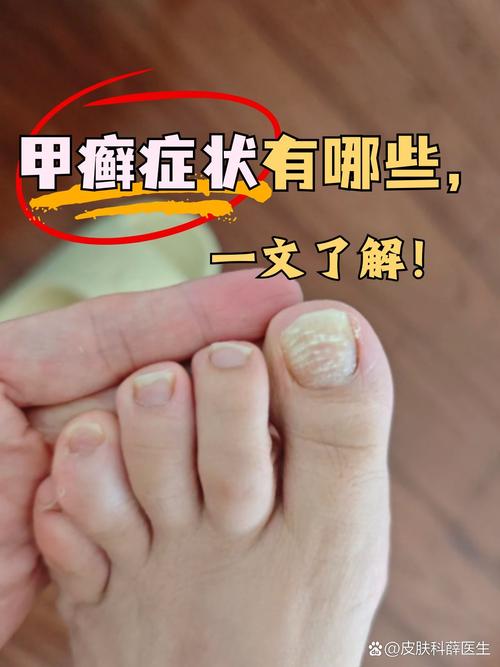 甲癣是什么病