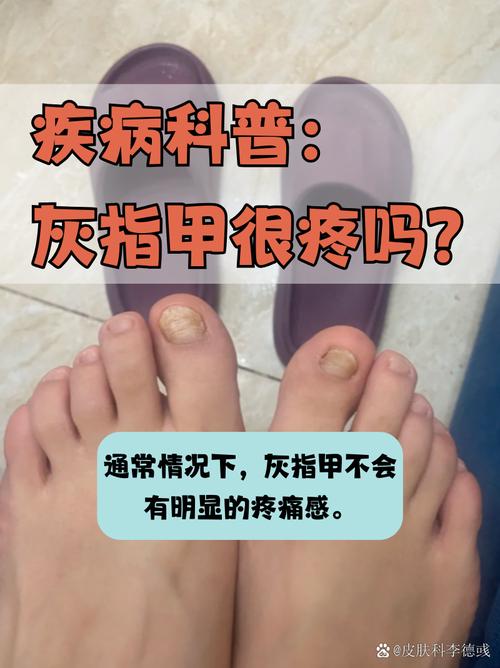 甲癣是什么病