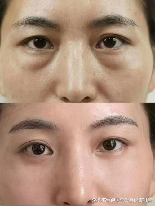 什么是黑眼圈什么是眼袋