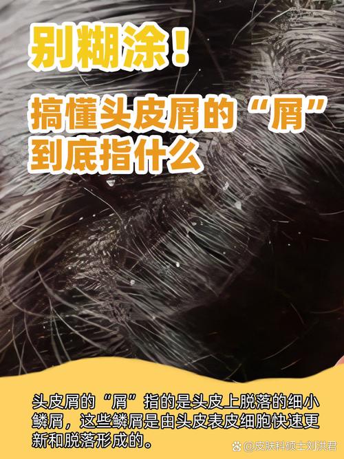 掉头皮屑是什么原因