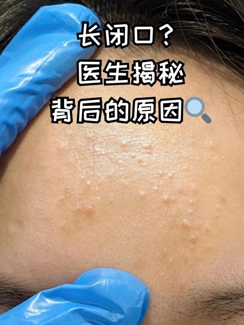 闭口粉刺是什么样的