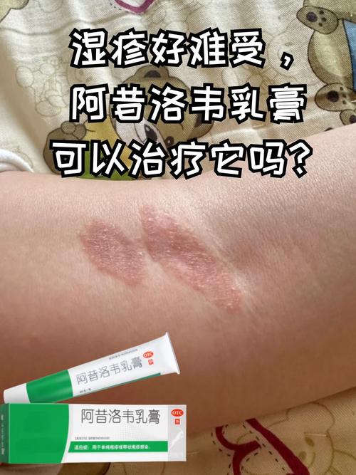 顽固性湿疹用什么药