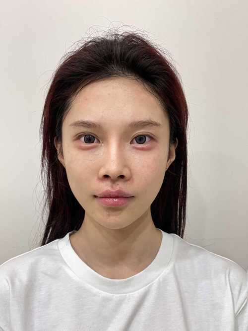 打卧蚕用什么玻尿酸