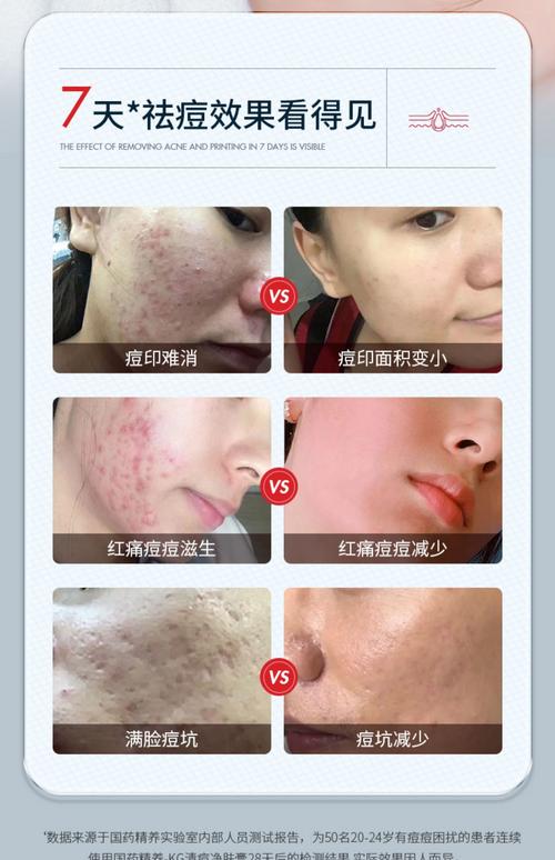 用什么去痘痘最有效