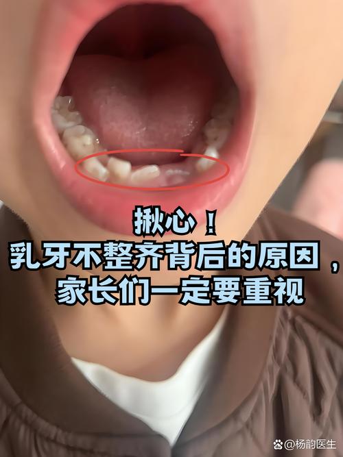 为什么牙齿会不整齐