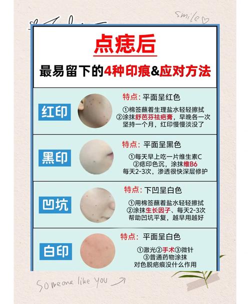 激光点痣要注意什么
