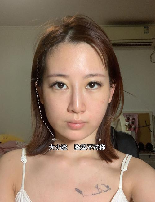 瘦脸针有什么效果