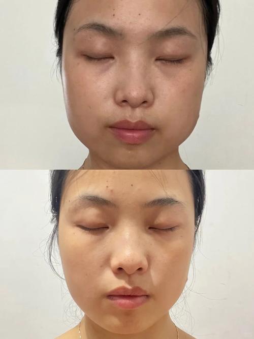 瘦脸针有什么效果