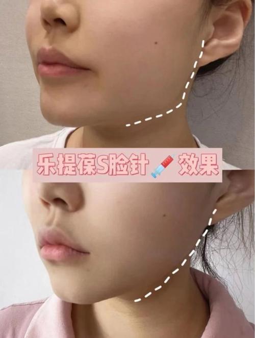 瘦脸针有什么效果