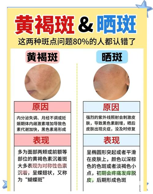 晒斑是什么样子的