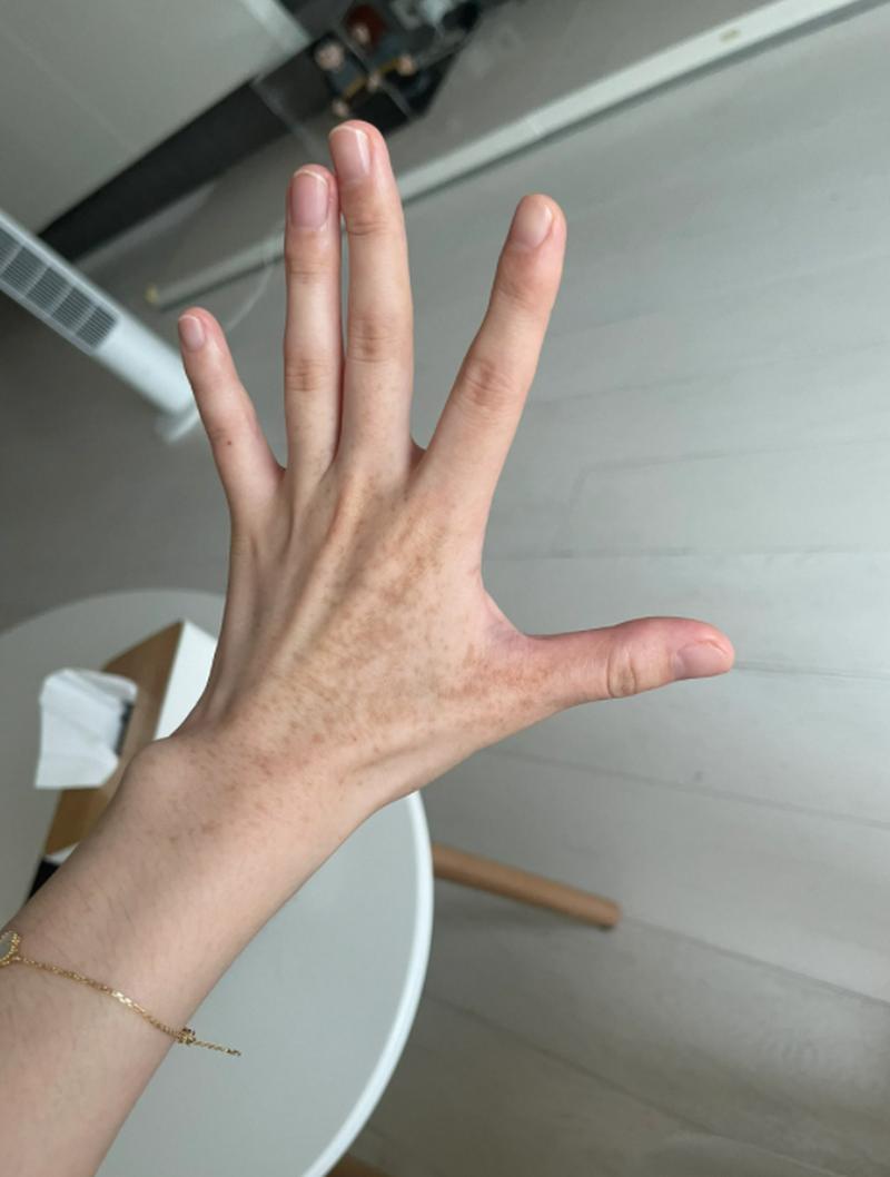 晒斑是什么样子的