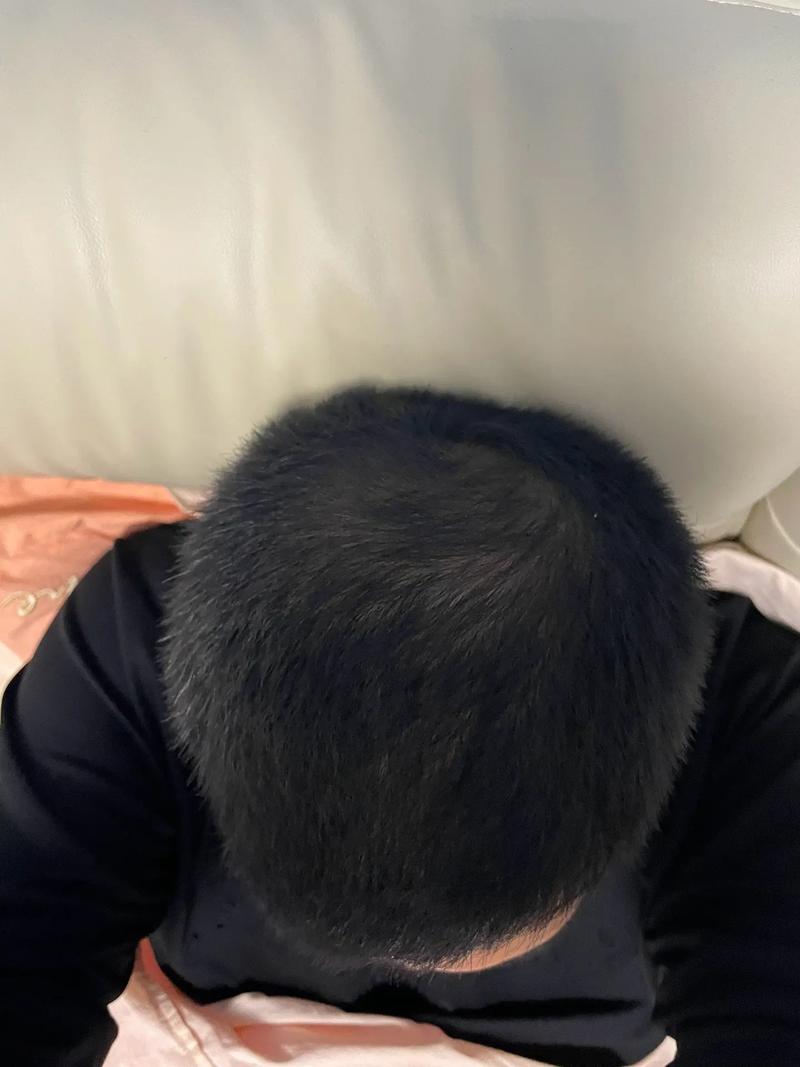 头顶秃留什么发型