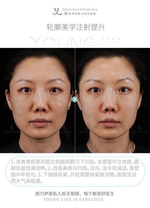面部提升针是什么
