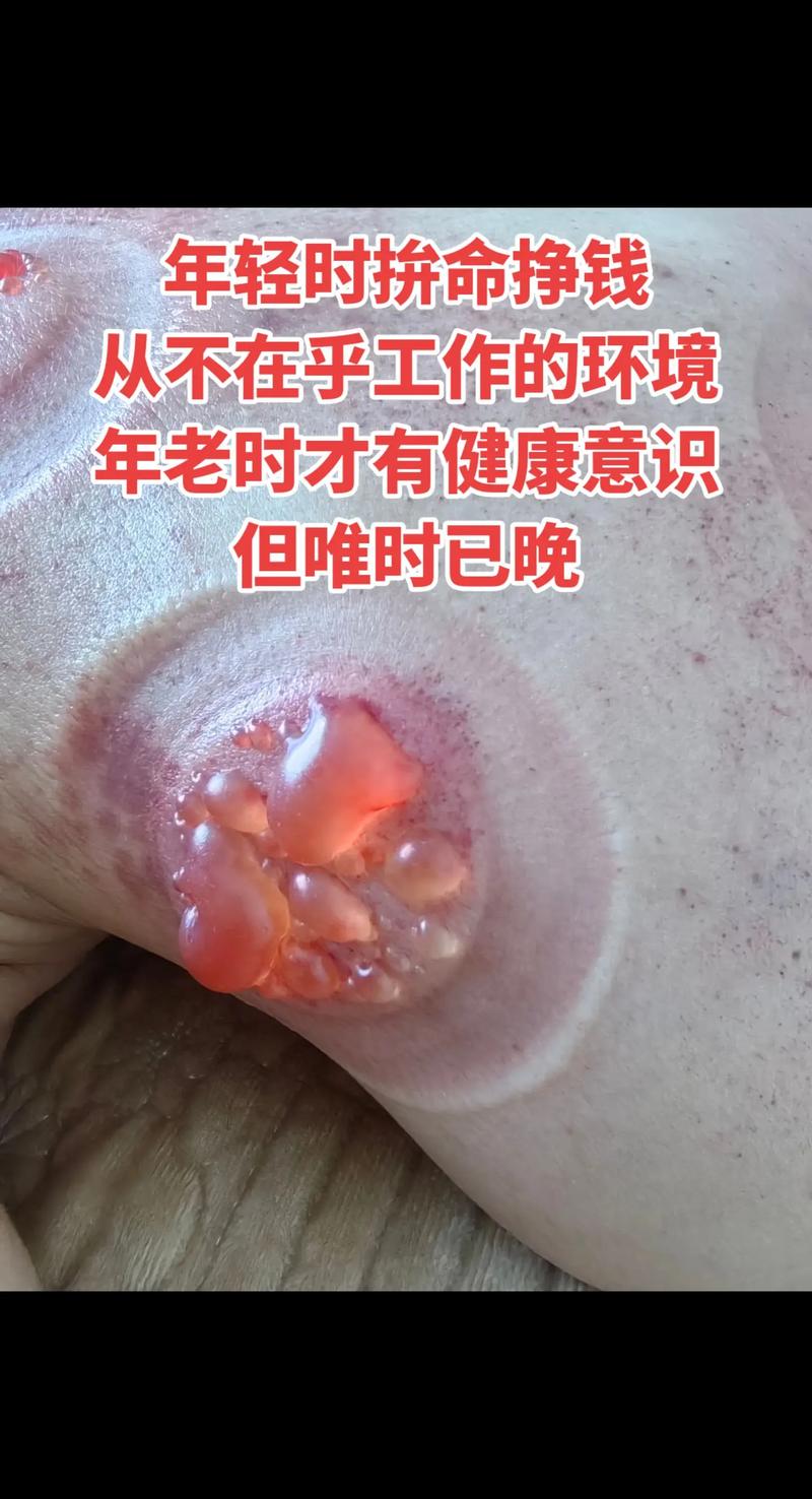 拔罐减肥都引起什么病
