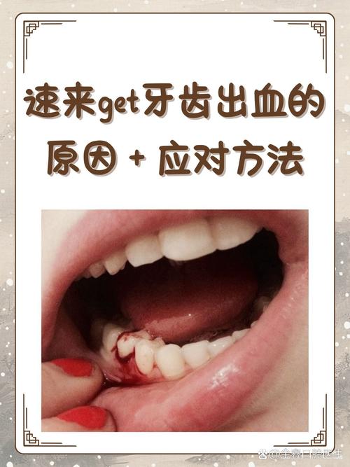 牙齿为什么经常出血