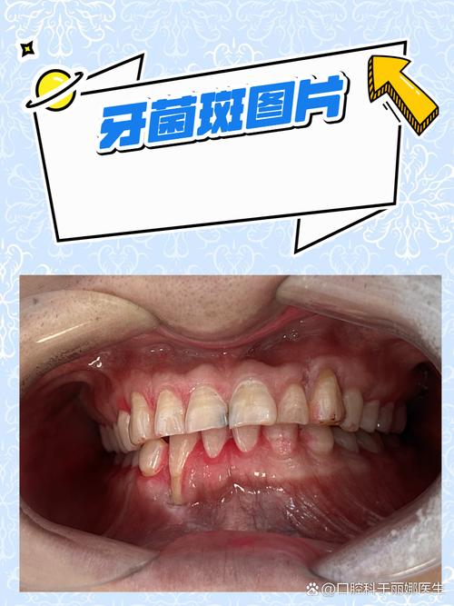 为什么会有牙菌斑