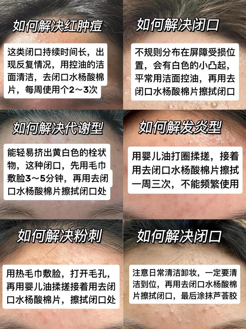 长粉刺用什么