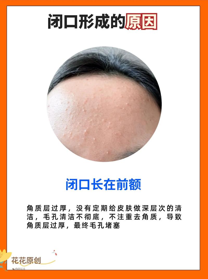 长粉刺用什么