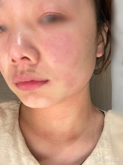 面膜过敏什么症状