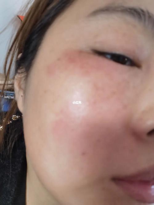 面膜过敏什么症状