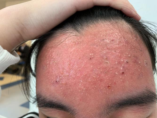 面膜过敏什么症状