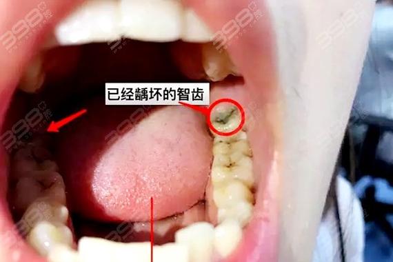 什么样的牙需要拔掉