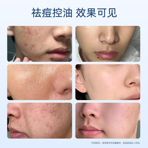 控油抗痘的洗面奶怎么样