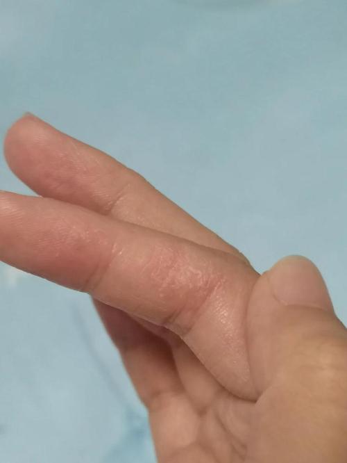 手心起皮是什么原因