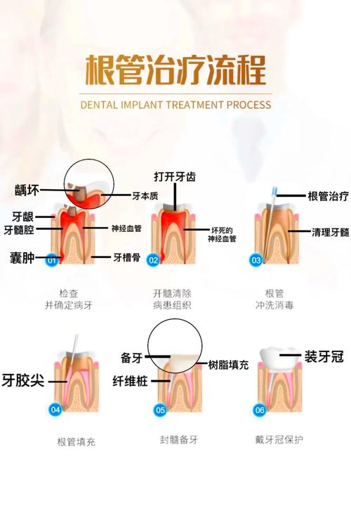 根管治疗有什么用