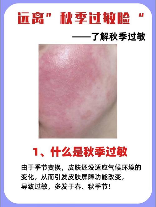 皮肤过敏要注意什么