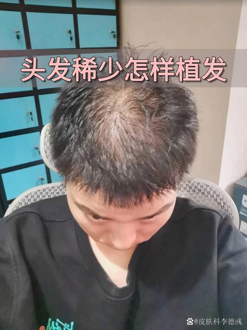 为什么头顶头发稀少