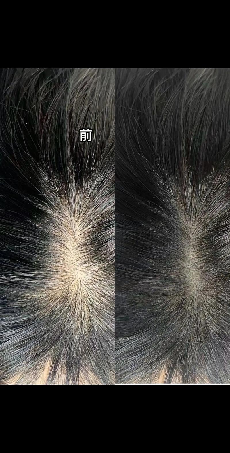 为什么头顶头发稀少