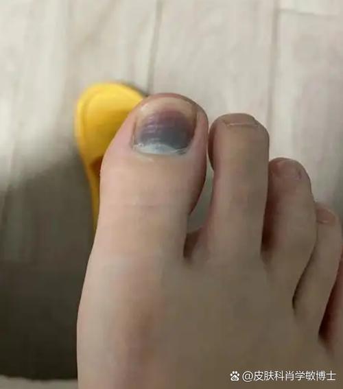 黑指甲是什么症状