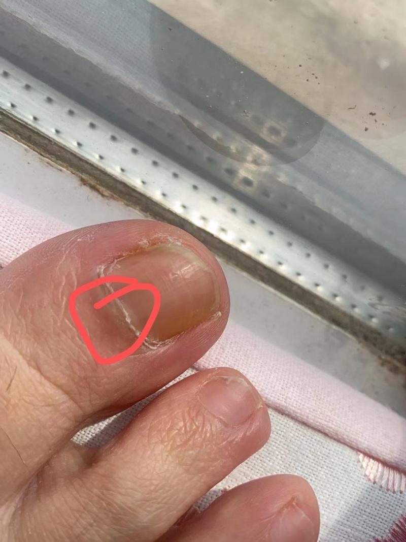 黑指甲是什么症状
