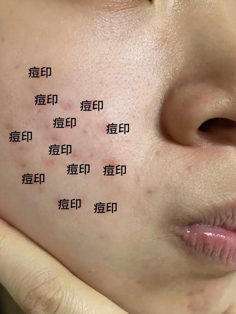 什么能去除痘印