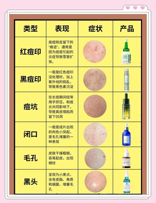 什么能去除痘印