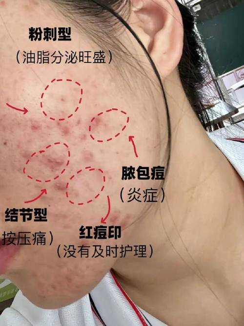 痘痘为什么会化脓