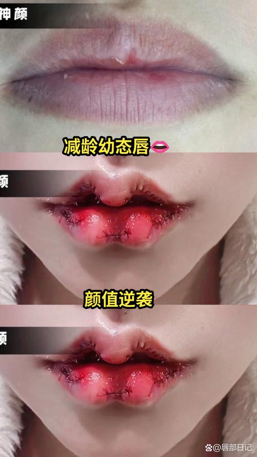 什么是m唇