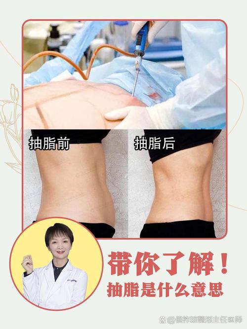 最新抽脂是怎么抽的