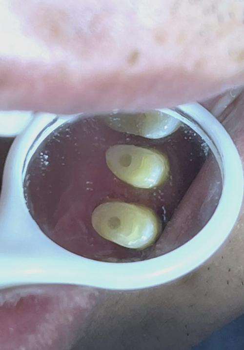 什么是牙齿打桩