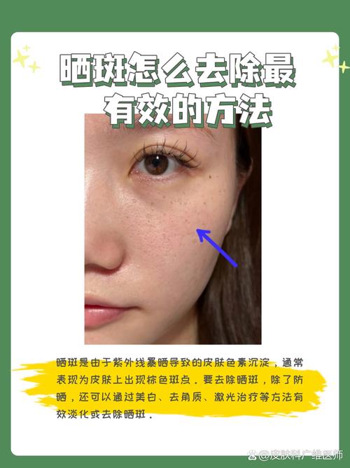 什么可以淡化斑点