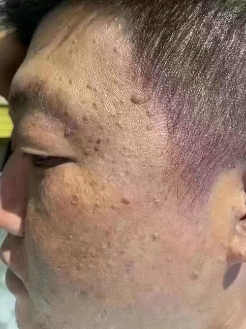 脸上为什么长扁平疣