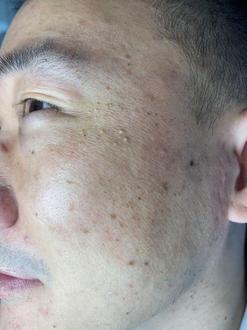 脸上为什么长扁平疣