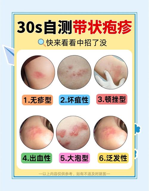 什么原因引起带状疱疹