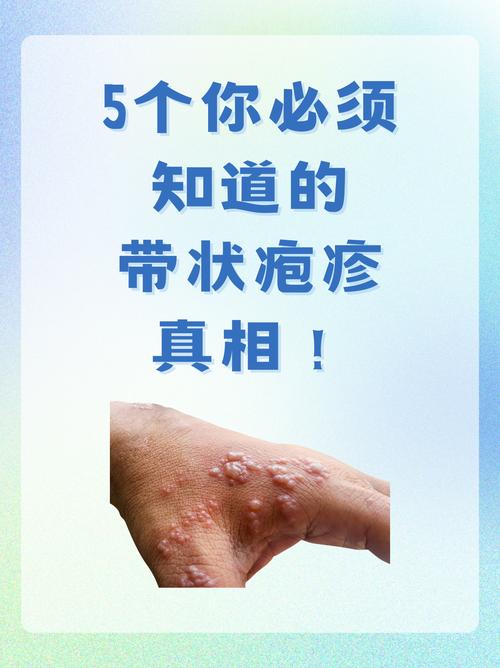什么原因引起带状疱疹